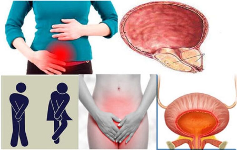 Signs of cystitis in women - burning sensation and pain during urination